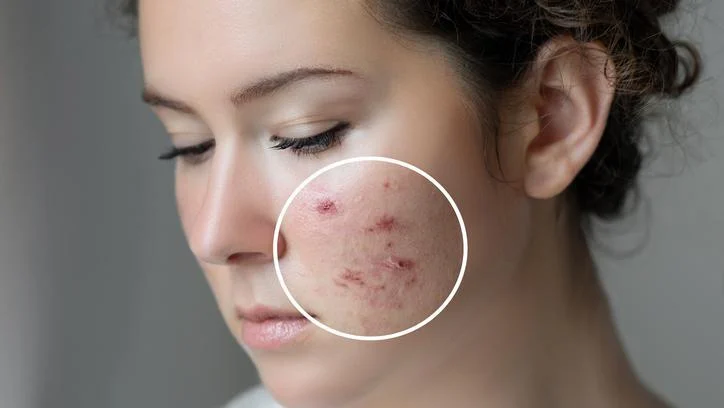 beyond-topical-treatments-the-nutritional-blueprint-for-clearer-acne-free-skin