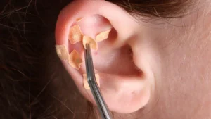 beyond-the-k-pop-aesthetic-the-rise-of-ear-seeds-as-a-viral-wellness-trend-and-what-medical-experts-say
